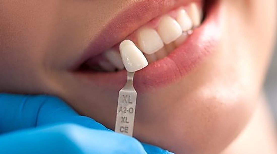 Dental Implants
